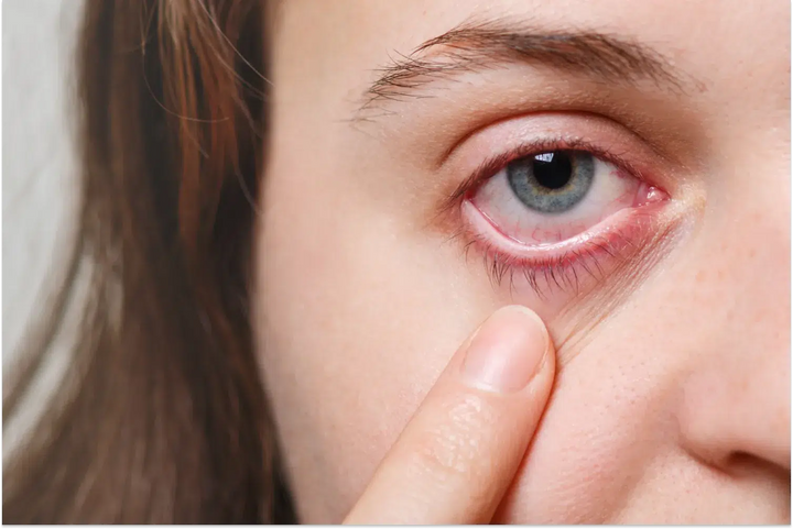 Does CBD Make Your Eyes Red?